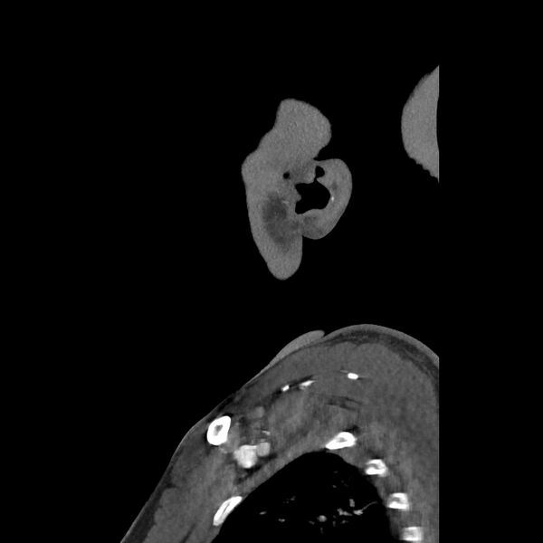 File:Buccal fat pad arteriovenous malformation (Radiopaedia 70936-81144 C 73).jpg