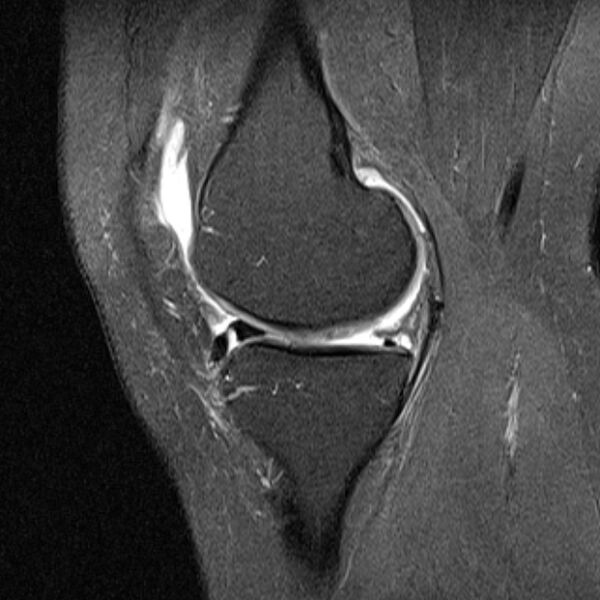 File:Bucket handle tear - medial meniscus (Radiopaedia 79028-91942 Sagittal PD fat sat 17).jpg