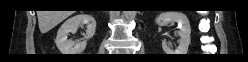 File:Buried bumper syndrome - gastrostomy tube (Radiopaedia 63843-72575 Coronal 30).jpg