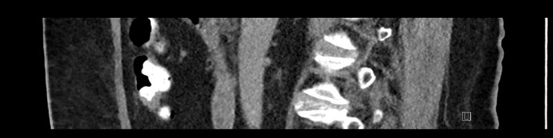 File:Buried bumper syndrome - gastrostomy tube (Radiopaedia 63843-72575 Sagittal Inject 73).jpg