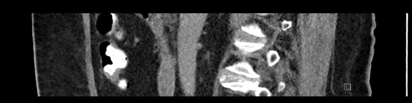 Buried bumper syndrome - gastrostomy tube (Radiopaedia 63843-72575 Sagittal Inject 73).jpg