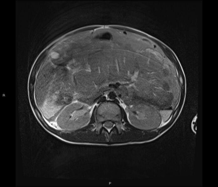 File:Burkitt lymphoma (bowel) (Radiopaedia 68839-78557 Axial T2 25).jpg