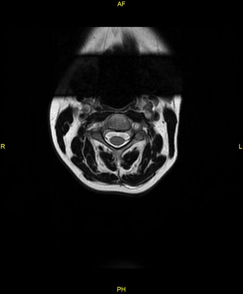 File:C5 nerve sheath tumor (Radiopaedia 85777-101596 Axial T2 3).jpg
