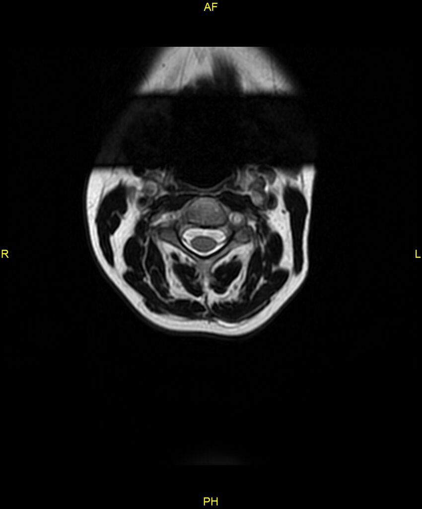 C5 nerve sheath tumor (Radiopaedia 85777-101596 Axial T2 3).jpg