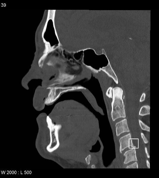 File:Calcification of the transverse band of the cruciform ligament (Radiopaedia 53063-59025 Sagittal bone window 16).jpg