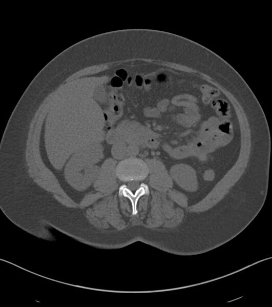 File:Calcified hepatic hydatid cyst (Radiopaedia 81127-94738 Axial non-contrast 47).jpg