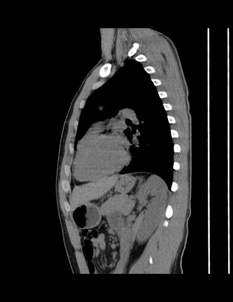 File:Calcifying pulmonary metastases (Radiopaedia 33359-34396 C 25).jpg