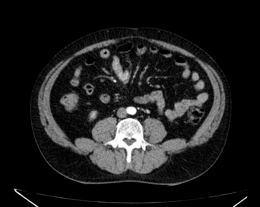 Carcinoid tumor with hepatic metastases (Radiopaedia 22651-22670 B 52).jpg