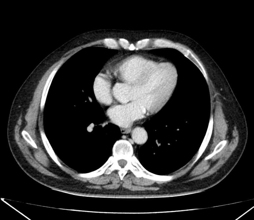 Carcinoid tumor with hepatic metastases (Radiopaedia 22651-22670 C 21).jpg