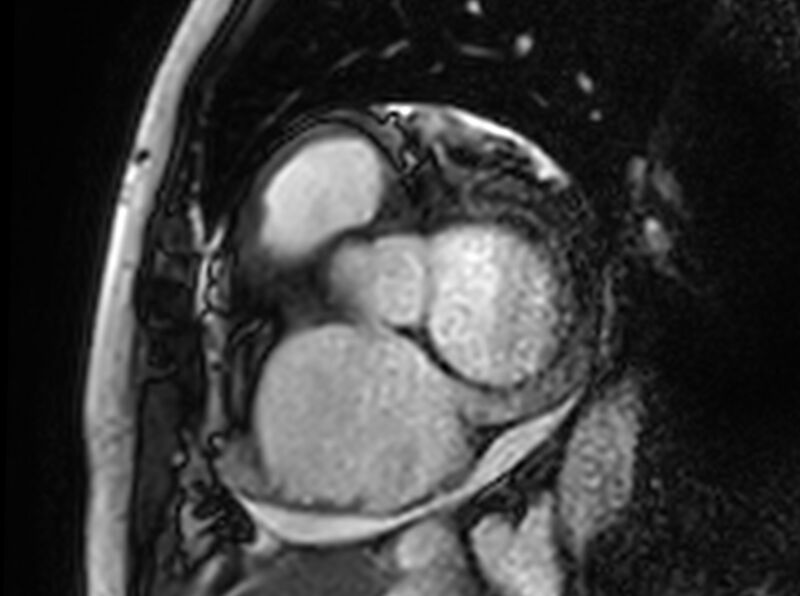 File:Cardiac amyloidosis (Radiopaedia 61600-69579 Short axis bSSFP 329).jpg