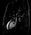 Cardiac hemangioma (Radiopaedia 16971-64065 Multiplanar 6).JPG