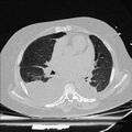 Cardiogenic pulmonary edema (Radiopaedia 29213-29609 Axial lung window 50).jpg