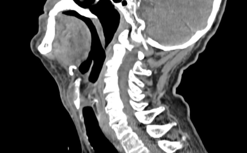File:Carotid artery pseudoaneurysm (Radiopaedia 84030-99259 E 1).jpg