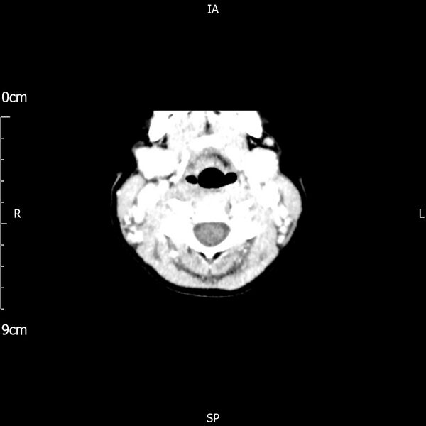 File:Cavernous sinus thrombosis (Radiopaedia 79414-92510 Axial Brain 11).jpg