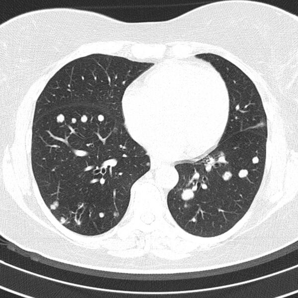 File:Cavitating pulmonary metastases (Radiopaedia 17796-17555 Axial lung window 13).jpg