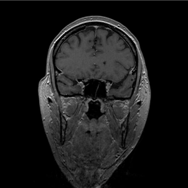File:Central base of skull meningioma (Radiopaedia 53531-59549 Coronal T1 C+ 1).jpg