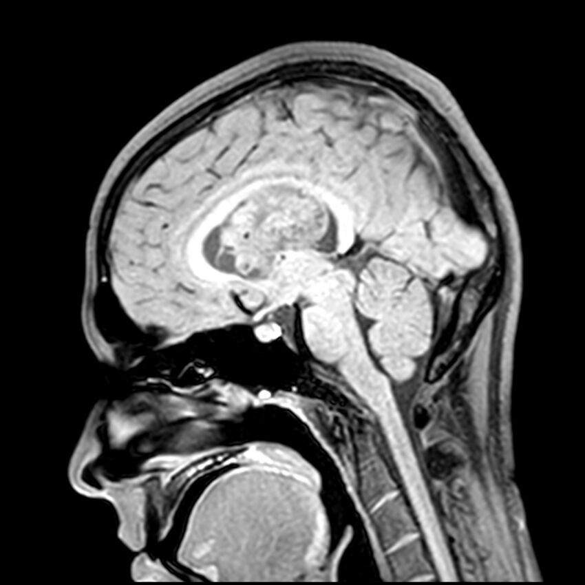 Central neurocytoma (Radiopaedia 79320-92380 Sagittal T1 134).jpg
