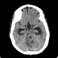 Cerebellar abscess secondary to mastoiditis (Radiopaedia 26284-26412 Axial non-contrast 57).jpg