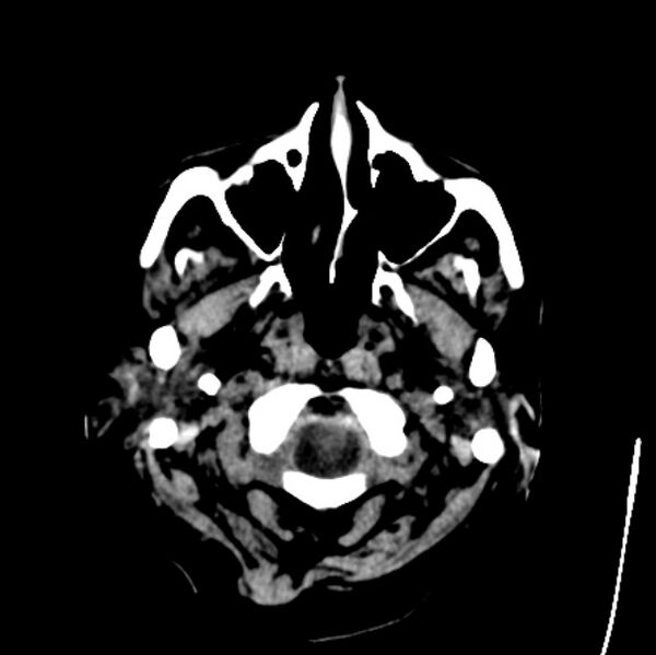 File:Cerebellar hemorrhage causing obstructive hydrocephalus (Radiopaedia 33989-35207 Axial non-contrast 1).jpg