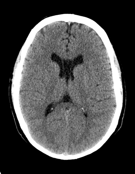 File:Cerebellar infarct due to vertebral artery dissection with posterior fossa decompression (Radiopaedia 82779-97030 Axial non-contrast 19).png