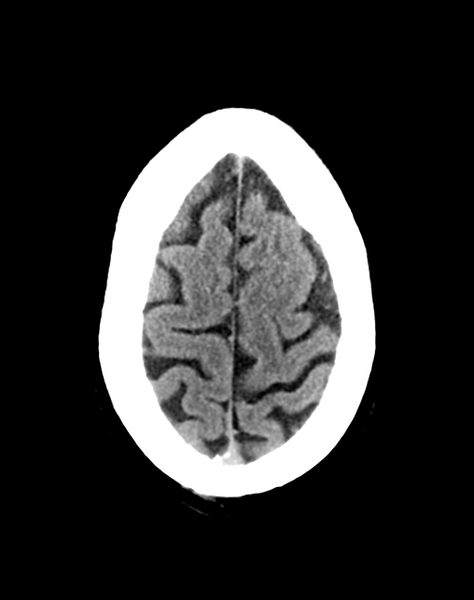 File:Cerebellar infarct due to vertebral artery dissection with posterior fossa decompression (Radiopaedia 82779-97033 Axial non-contrast 31).png
