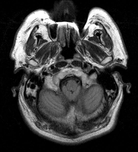 File:Cerebellopontine angle meningioma (Radiopaedia 24459-24764 Axial FLAIR 3).jpg