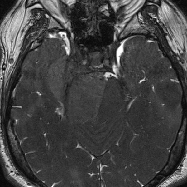 File:Cerebellopontine angle meningioma (Radiopaedia 24459-24764 I 31).jpg