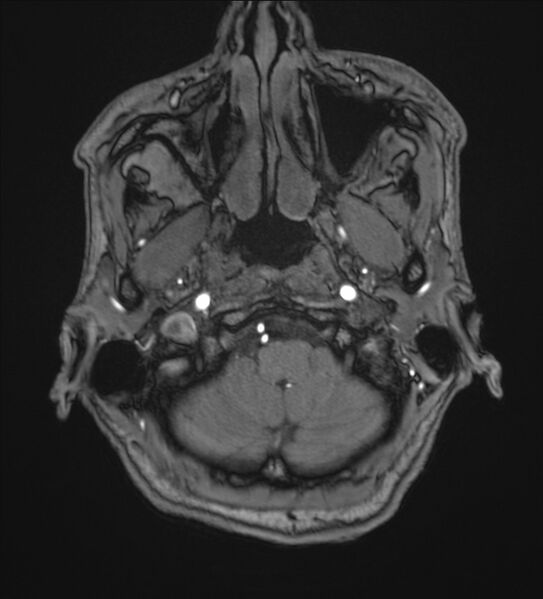 File:Cerebellopontine angle meningioma (Radiopaedia 72983-83680 Axial MRA 6).jpg