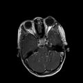 Cerebral abscess post cardiac surgery (Radiopaedia 27244-27420 Axial T1 C+ 4).jpg