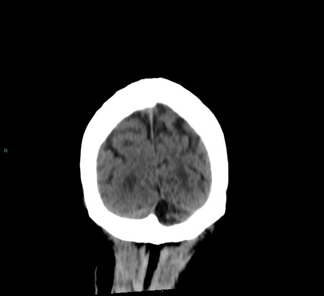 File:Cerebral amyloid angiopathy-associated lobar intracerebral hemorrhage (Radiopaedia 58376-65513 Coronal non-contrast 20).jpg