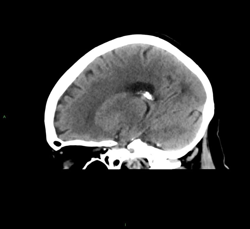 Cerebral amyloid angiopathy-associated lobar intracerebral hemorrhage (Radiopaedia 58378-65516 C 32).jpg