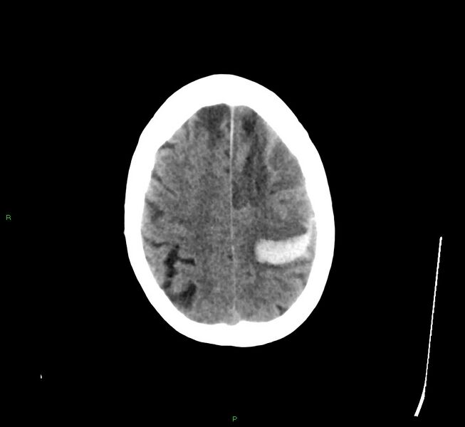 File:Cerebral amyloid angiopathy-associated lobar intracerebral hemorrhage (Radiopaedia 58529-65681 Axial non-contrast 12).jpg
