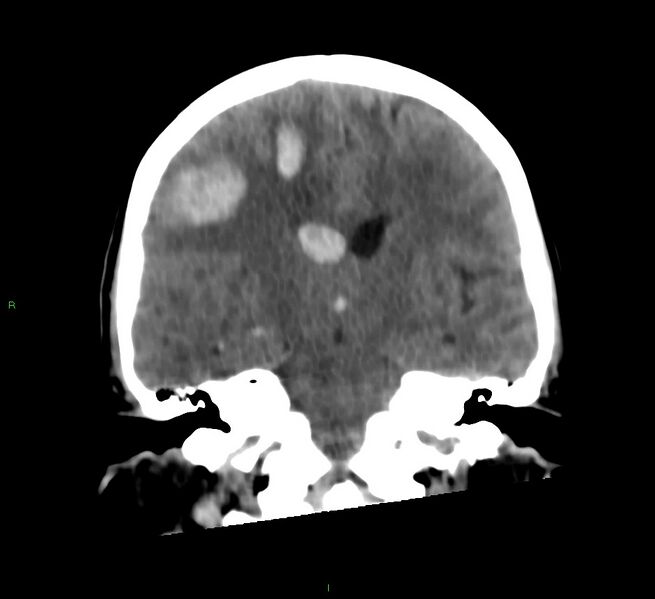 File:Cerebral amyloid angiopathy-associated lobar intracerebral hemorrhage (Radiopaedia 58566-65730 Coronal non-contrast 37).jpg