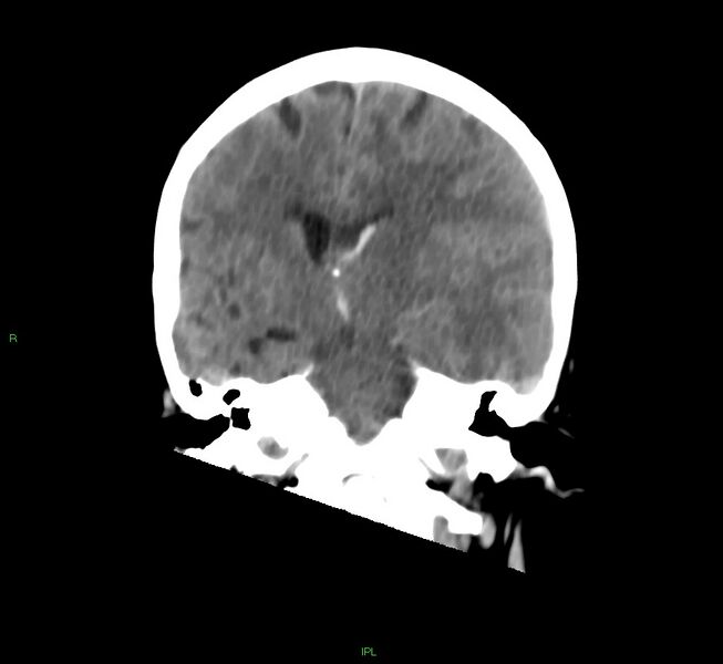 File:Cerebral amyloid angiopathy-associated lobar intracerebral hemorrhage (Radiopaedia 58754-65975 Coronal non-contrast 33).jpg