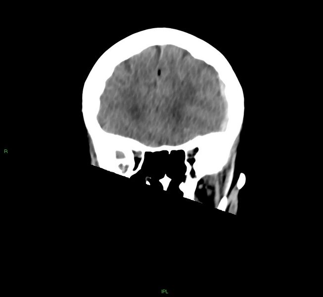 File:Cerebral amyloid angiopathy-associated lobar intracerebral hemorrhage (Radiopaedia 58754-65975 Coronal non-contrast 45).jpg