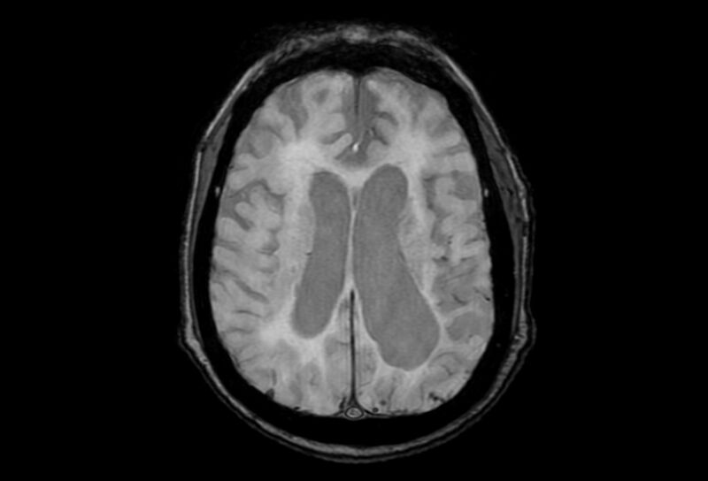 File:Cerebral amyloid angiopathy (Radiopaedia 86671-102792 Axial Gradient Echo 21).jpg