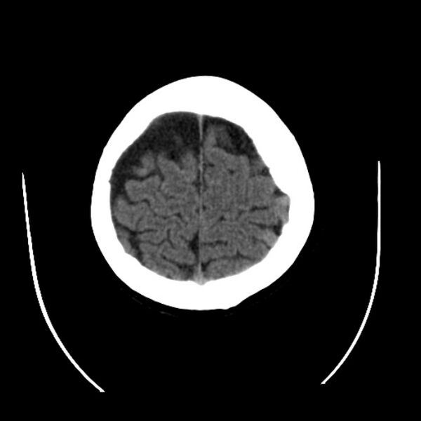 File:Cerebral arteriovenous malformation (Radiopaedia 43729-47189 Axial non-contrast 37).jpg