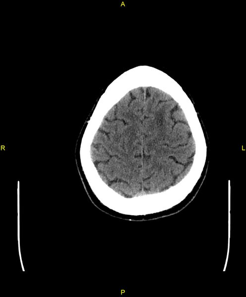 File:Cerebral autosomal dominant arteriopathy with subcortical infarcts and leukoencephalopathy (CADASIL) (Radiopaedia 86108-102051 Axial non-contrast 95).jpg
