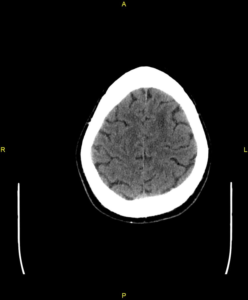 Cerebral autosomal dominant arteriopathy with subcortical infarcts and leukoencephalopathy (CADASIL) (Radiopaedia 86108-102051 Axial non-contrast 95).jpg