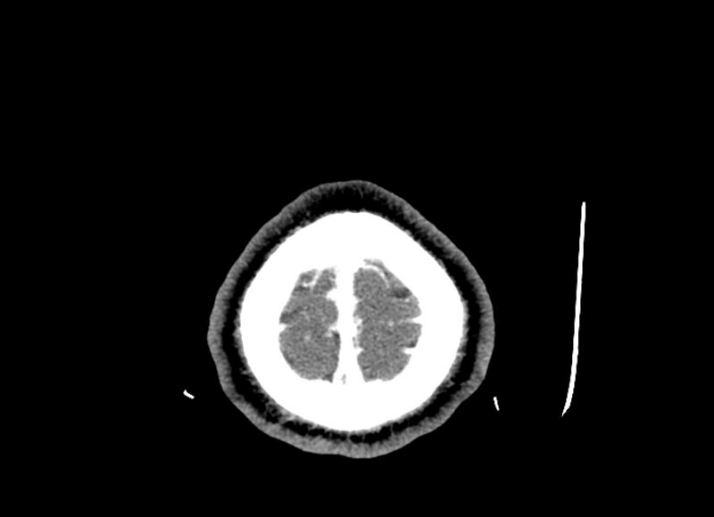 File:Cerebral edema (Radiopaedia 82519-96661 B 7).jpg