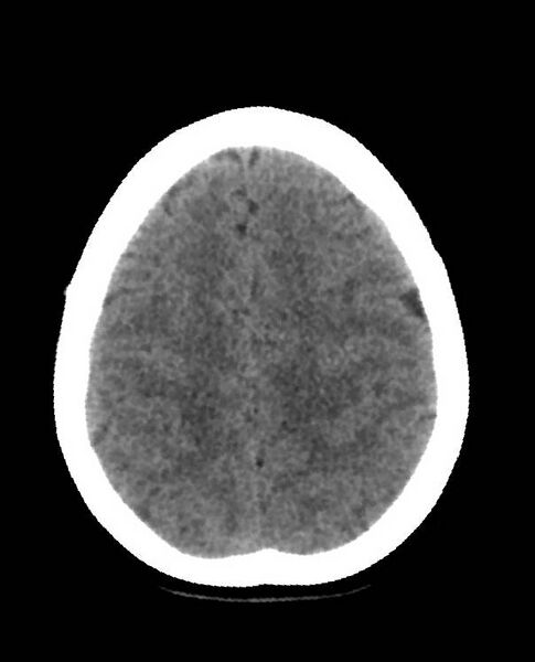 File:Cerebral edema due to severe hyponatremia (Radiopaedia 89826-106938 Axial non-contrast 80).jpg