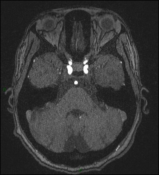 File:Cerebral fat embolism (Radiopaedia 35022-36525 Axial TOF 52).jpg