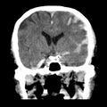 Cerebral hemorrhagic contusions (Radiopaedia 23145-23188 Coronal non-contrast 19).jpg