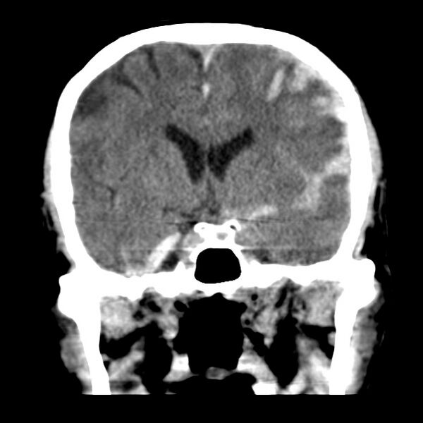 File:Cerebral hemorrhagic contusions (Radiopaedia 23145-23188 Coronal non-contrast 19).jpg