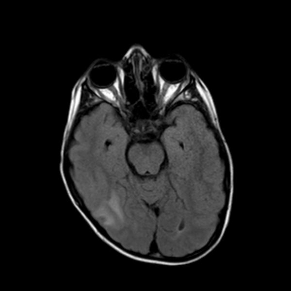 File:Cerebral tuberculoma (Radiopaedia 41152-43932 Axial FLAIR 8).jpg