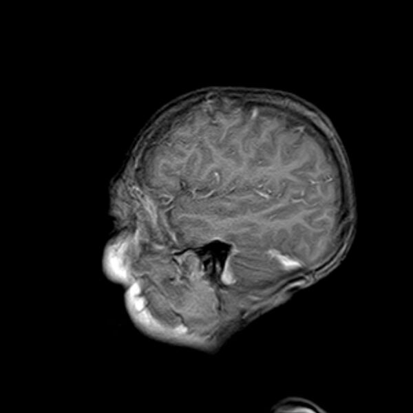 File:Cerebral tuberculoma (Radiopaedia 41152-43932 Sagittal T1 C+ 3).jpg
