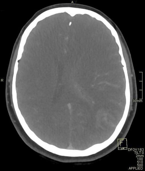 File:Cerebral venous sinus thrombosis (Radiopaedia 91329-108965 Axial venogram 49).jpg