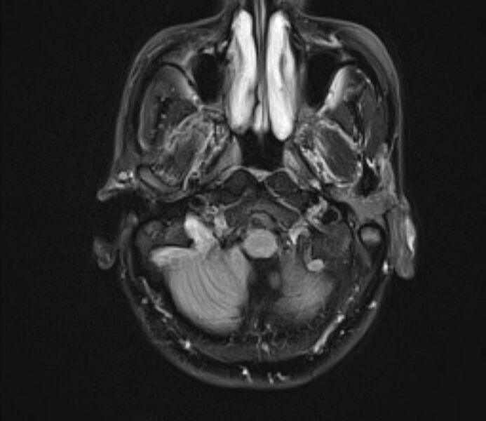 File:Cerebral venous thrombosis (Radiopaedia 71207-81504 Axial FLAIR 5).jpg