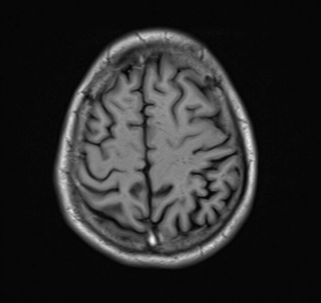 File:Cerebral venous thrombosis (Radiopaedia 71207-81504 Axial T1 20).jpg