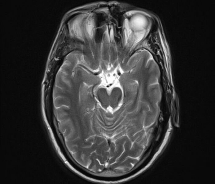 File:Cerebral venous thrombosis (Radiopaedia 71207-81504 Axial T2 11).jpg